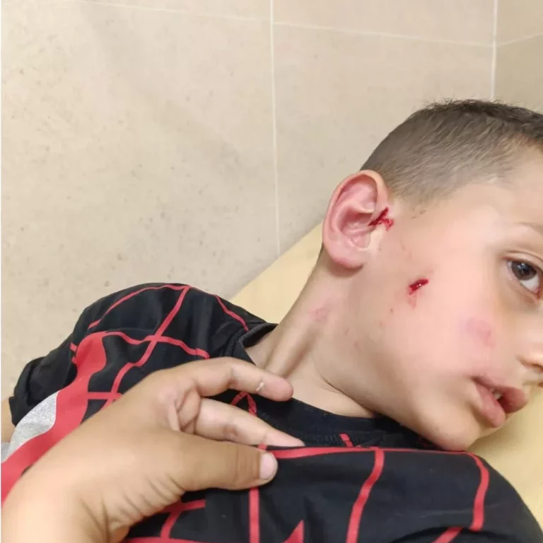 Child bitten by dog